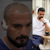 کاشت تخصصی و فول تراکم مو باشرایط نقدواقساط