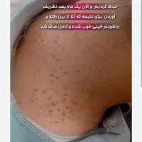 لیزر خال، خال گوشتی خال پیله منگوله پاکسازی درمانی|خدمات آرایشگری و زیبایی|هشتگرد, هشتگرد قدیم|دیوار