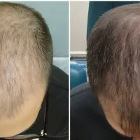 پی آر پی و مزوتراپی مو و ابرو|خدمات آرایشگری و زیبایی|اردبیل, |دیوار