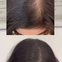 احیای مو و بازگشت به تراکم طبیعی