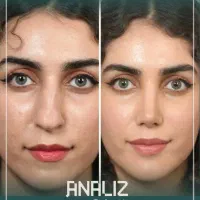 آفر ویژه عمل بینی /پلک /دندان/لیپوساکشن/غبغب