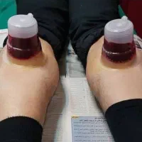 حجامت وبادکش