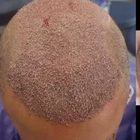 کاشت مو / ریش|خدمات آرایشگری و زیبایی|خرمآباد, |دیوار