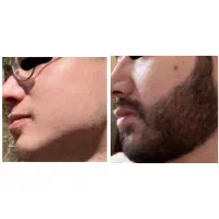 بنب رویش ریش و سبیل تضمینی