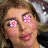 تزریق ژل،بوتاکس،فیلر،مزوتراپی،پی آر پی لیزر  هایفو|خدمات آرایشگری و زیبایی|اردبیل, |دیوار