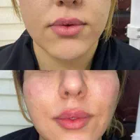 تزریق، فیلر ، بوتاکس، ژل ، آنزیم|خدمات آرایشگری و زیبایی|شیراز, سینما سعدی|دیوار