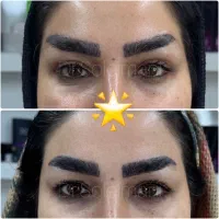 تخفیف ویژه بلفارو (بلفاروپلاستی) ،لیفت ابرو وغبغب