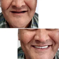 ترمیم عصب کشی روکش کامپوزیت زیبایی|خدمات آرایشگری و زیبایی|اردبیل, |دیوار