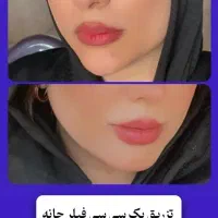 تخفیفات روزمادر تزریق ژل بوتاکس،مزوتراپی،فیلر بادی|خدمات آرایشگری و زیبایی|قم, باسکول|دیوار