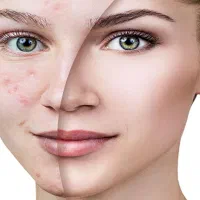 با فیشال تخصصی کلینیک لک و جوش خود را از بین ببر|خدمات آرایشگری و زیبایی|بندرعباس, |دیوار