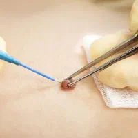 خال،زگیل کرایوتراپی فریززگیل تناسلی شاهین ویلا