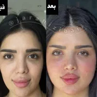 پکیج جوانسازی صورت با هایفو ۷بعدی