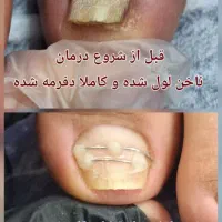 درمان ناخن های پا