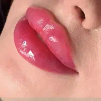 تزریق ژل و بوتاکس با تخفیف تابستانه
