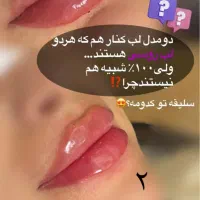 جشنواره عیدانه لیفت/فیلر باسن/ ژل/بلفارو