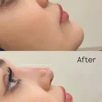 ژل بوتاکس آنزیم مزوتراپی پرسینگ فشیال فیلر|خدمات آرایشگری و زیبایی|مشهد, صیاد شیرازی|دیوار