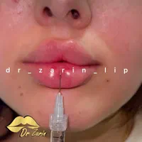 تزریق تخصصی فیلر زیر چشم بینی ژل لب روسی لیفت گونه|خدمات آرایشگری و زیبایی|تهران, پونک|دیوار