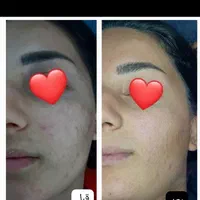 خدمات زیبایی بوتاکس ، ژل ،مزوتراپی، ریمو تتو هایفو|خدمات آرایشگری و زیبایی|فولادشهر, B2|دیوار