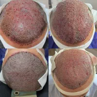دعوت به همکاری کاشت کار حرفه‌ای مو