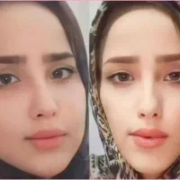 چاقی و طراوت وجوانی صورتتان را برمیگردانیم