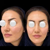 جشواره ۵۰درصدی ژل،بوتاکس،چربی،پاک کردن تتو