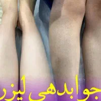 لیزر موهای زائد لیزر آلکساندریت کندلا آمریکایی