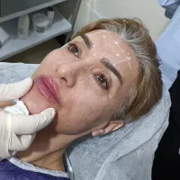 لیرز موهای زاید، ژل، بوتاکس