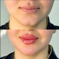 تزریق ژل ، بوتاکس و آنزیم ،اندیشه