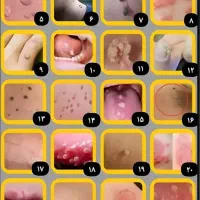 درمان قطعی زگیل و تبخال تناسلی