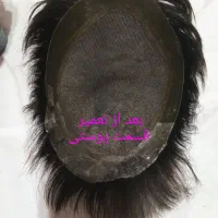 تعمیر تخصصی پروتز مو