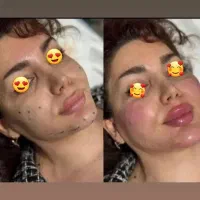 تزریق ژل بوتاکس offویژه برای خانماآقایان مدت محدود