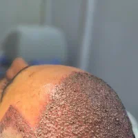 کاشتمو /کاشت مو/ کاشت ابرو