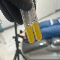 پی ار پی برای جوانسازی صورت، قطع ریزش مو، prp رشت