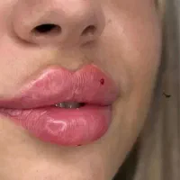مدل برای تزریق ژل لب هر سی سی ۶۷۰ فقط|خدمات زیبایی و سلامت|تهران, سلسبیل جنوبی|دیوار