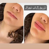 آف هفتگی تزریق ژل وبوتاکس ومزوژل جوانساز