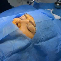 تخفیف ویژه شب یلدا برای جراحی بلفاروپلاستی