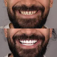 دندانپزشکی کامپوزیت بلچینگ جرم گیری