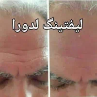 بوتاکس خانگی (کرم لیفتینگ تضمینی)