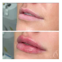 کیلینیک نوین تزریق ژل چربی بوتاکس مزو پی آرپی