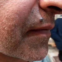 برداشتن خال زگیل و میخچه با محلول صدر صد گیاهی|آرایشی، بهداشتی، درمانی|کرمان, |دیوار