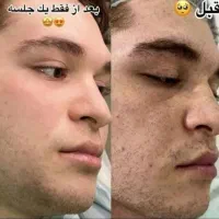 درمان و لیزر تضمینی کک و مک و لک فقط در 1 جلسه|خدمات آرایشگری و زیبایی|اصفهان, لاله|دیوار