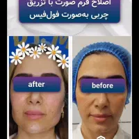 طرح اقساطی ویژه تزریق فول فیس فیلر/بایوفت و نانوفت|خدمات آرایشگری و زیبایی|مشهد, هنرستان|دیوار