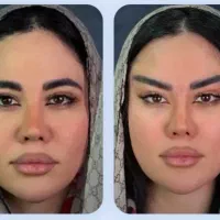 بوتاکس‌یک نفر