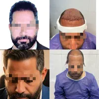جشنواره کاشت مو و ابرو