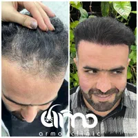 کاشت مو ابرو ریش تکنسین شیرازی|خدمات آرایشگری و زیبایی|قزوین, |دیوار