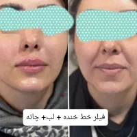 ٪50 آفر مزو prp بوتاکس فیلر لب زاویه سازی فیلرچانه|خدمات آرایشگری و زیبایی|مشهد, وکیل‌آباد|دیوار