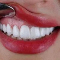 دندانپزشکی ، ایمپلنت، روکش، کامپوزیت ، عصب کشی|خدمات آرایشگری و زیبایی|کوهدشت, |دیوار