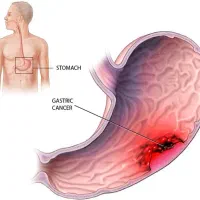 بهبود مشکلات گوارشی یبوست ونفخ معده