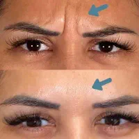 خدمات تخصصی بوتاکس و فیلر در منزل (پزشک مجرب)|خدمات آرایشگری و زیبایی|تهران, اباذر|دیوار