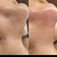 اپلاسیون و پاکسازی